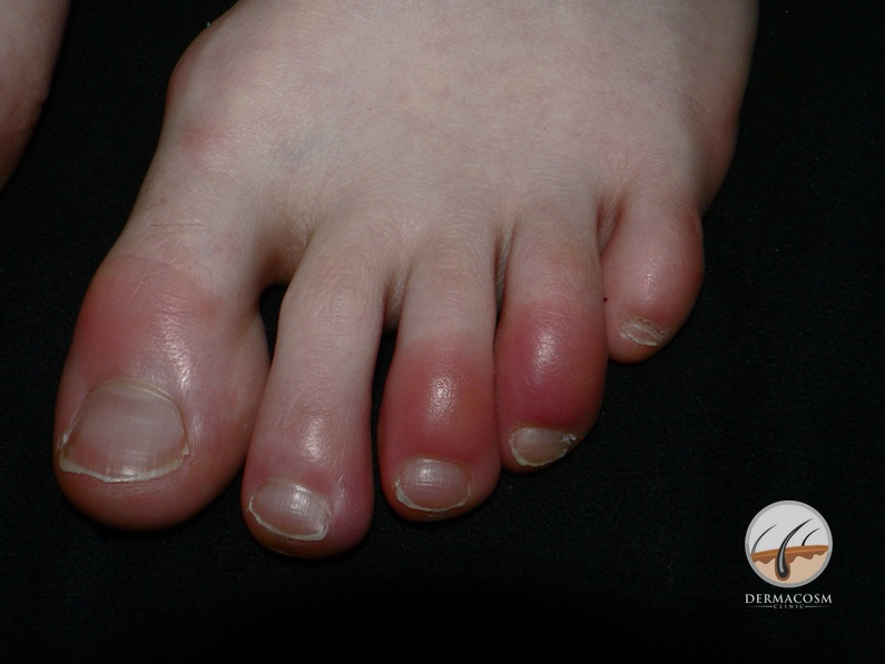 chilblains