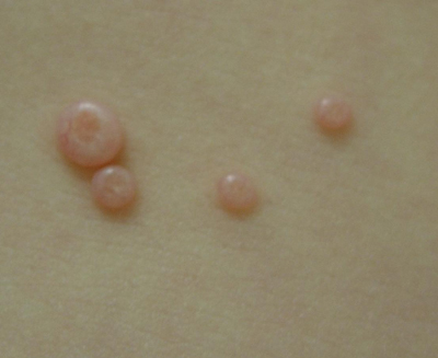 molluscum
