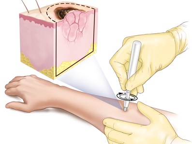 skin biopsy